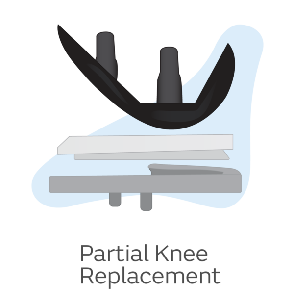 Knee Replacement Surgery with VERILAST Knee Technology